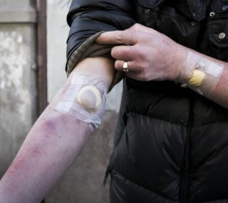 L'hépatite C sera éradiquée en tant que problème de santé publique en Norvège 5 L'hépatite C sera éradiquée en tant que problème de santé publique en Norvège - 4