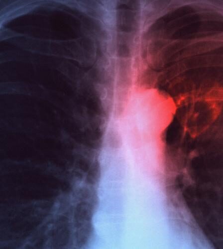 Personne infectée par la tuberculose à Bergen 12 Personne infectée par la tuberculose à Bergen - 11