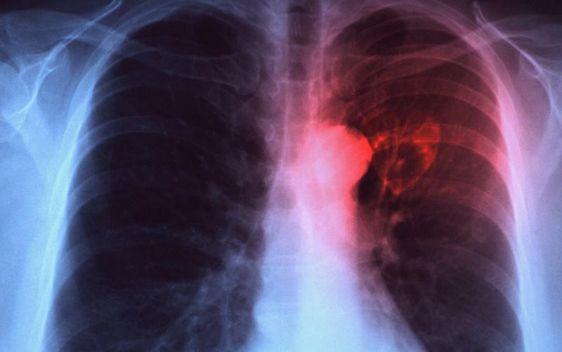 Personne infectée par la tuberculose à Bergen 4 Personne infectée par la tuberculose à Bergen - 3