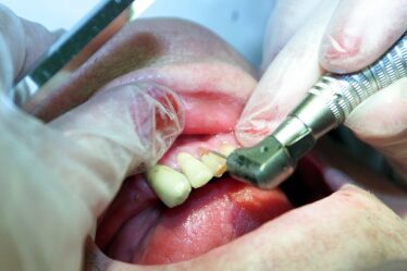 Anesthésie complète pour les enfants chez le dentiste - 18