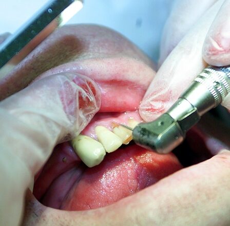 Anesthésie complète pour les enfants chez le dentiste 5 Anesthésie complète pour les enfants chez le dentiste - 4