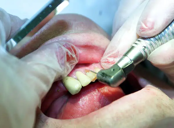 Anesthésie complète pour les enfants chez le dentiste 4 Anesthésie complète pour les enfants chez le dentiste - 3