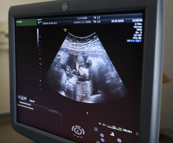 Pénurie de sages-femmes en Norvège - Norway Today 4 Pénurie de sages-femmes en Norvège - Norway Today - 3