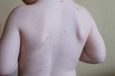 La varicelle frappe les enfants norvégiens en vacances à l'étranger - 18