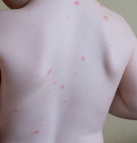 La varicelle frappe les enfants norvégiens en vacances à l'étranger 11 La varicelle frappe les enfants norvégiens en vacances à l'étranger - 10