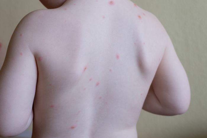 La varicelle frappe les enfants norvégiens en vacances à l'étranger 4 La varicelle frappe les enfants norvégiens en vacances à l'étranger - 3