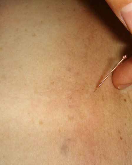 Un homme est mort après un traitement d'acupuncture 11 Un homme est mort après un traitement d'acupuncture - 10