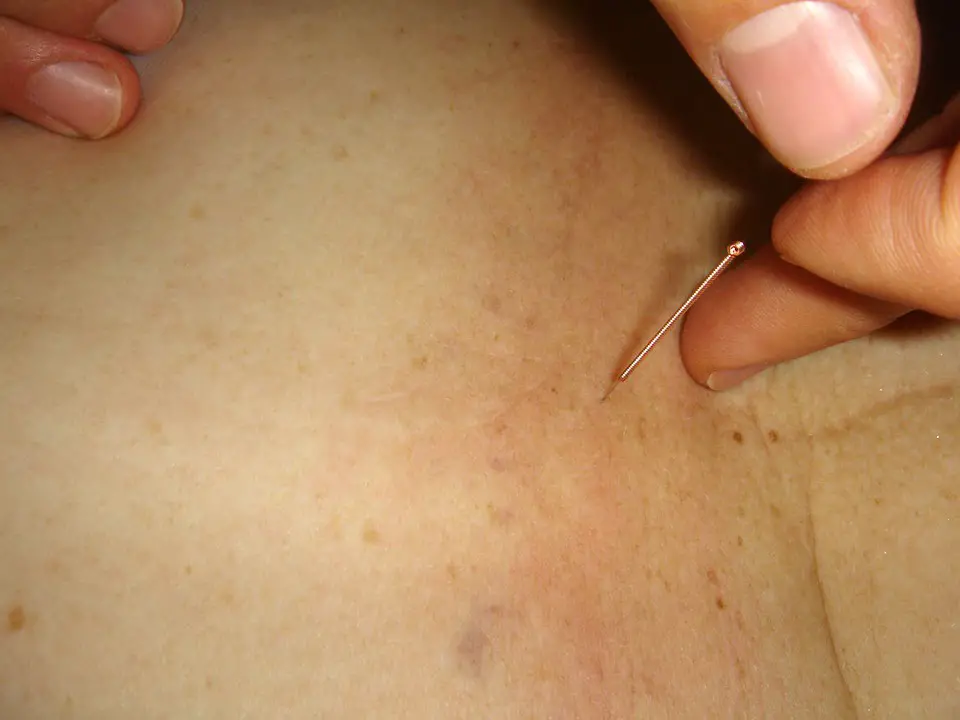 Un homme est mort après un traitement d'acupuncture 4 Un homme est mort après un traitement d'acupuncture - 3