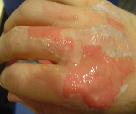 Le nombre de brûlés en hausse 5 Le nombre de brûlés en hausse - 4