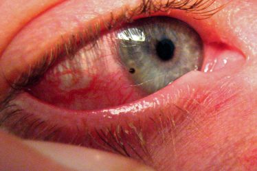 Craignant une autre célébration du Nouvel An avec des blessures aux yeux - 20