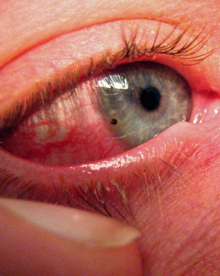 Craignant une autre célébration du Nouvel An avec des blessures aux yeux 5 Craignant une autre célébration du Nouvel An avec des blessures aux yeux - 4