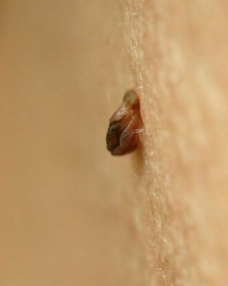 Forte augmentation du nombre de cas de cancer de la taupe détectés en Norvège enregistrés au cours des dix dernières années - 22