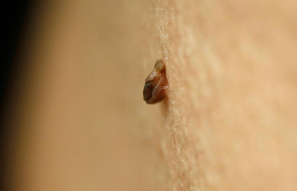 Forte augmentation du nombre de cas de cancer de la taupe détectés en Norvège enregistrés au cours des dix dernières années - 3