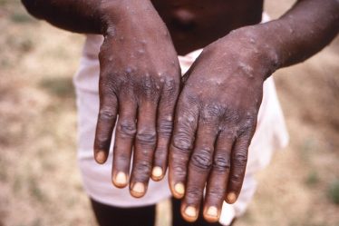 NRK : 34 cas de monkeypox enregistrés en Norvège - 18