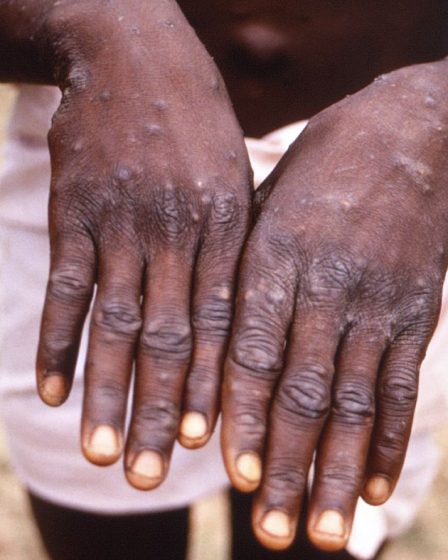 NRK : 34 cas de monkeypox enregistrés en Norvège - 11