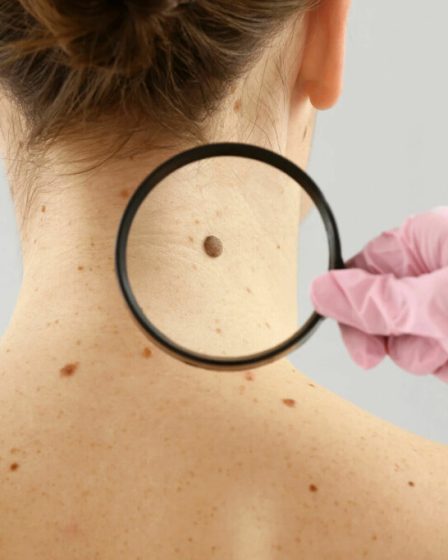 Augmentation spectaculaire du nombre de cancers de la peau en Norvège - 15