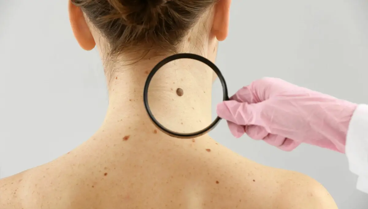 Augmentation spectaculaire du nombre de cancers de la peau en Norvège 4 Augmentation spectaculaire du nombre de cancers de la peau en Norvège - 3